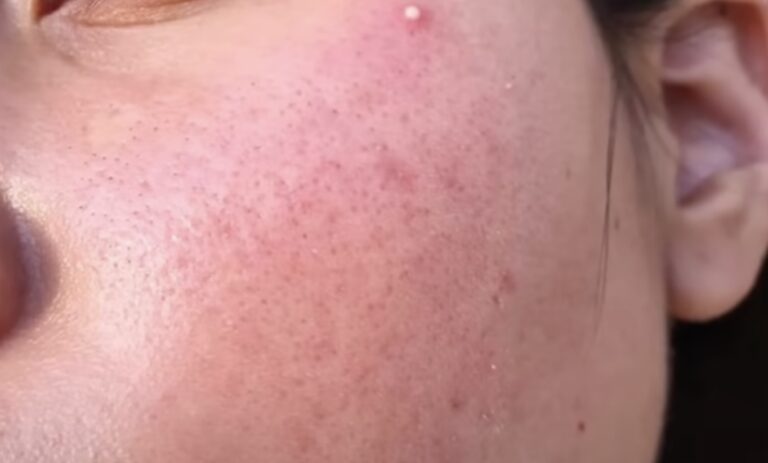 Ciri Skin Barrier Rusak