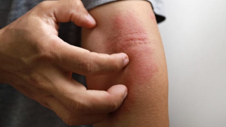 Cara Menghilangkan Gatal pada Kulit yang Tak Kunjung Sembuh