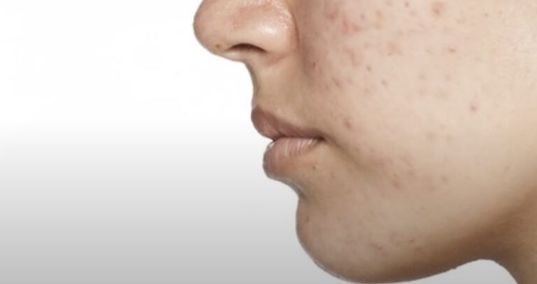 Cara Murah Hilangkan Bekas Jerawat
