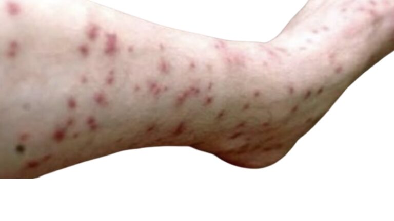 Cara Terjangkau Hilangkan Bekas Luka Pada Kulit