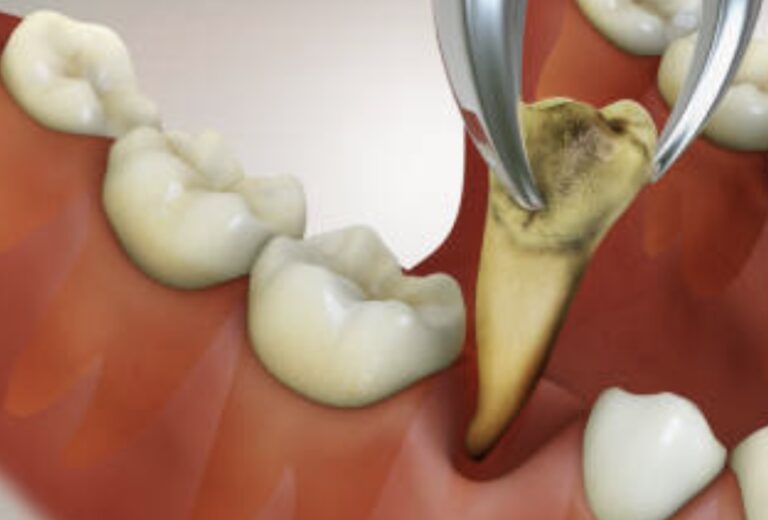 Berapa Biaya Cabut Gigi