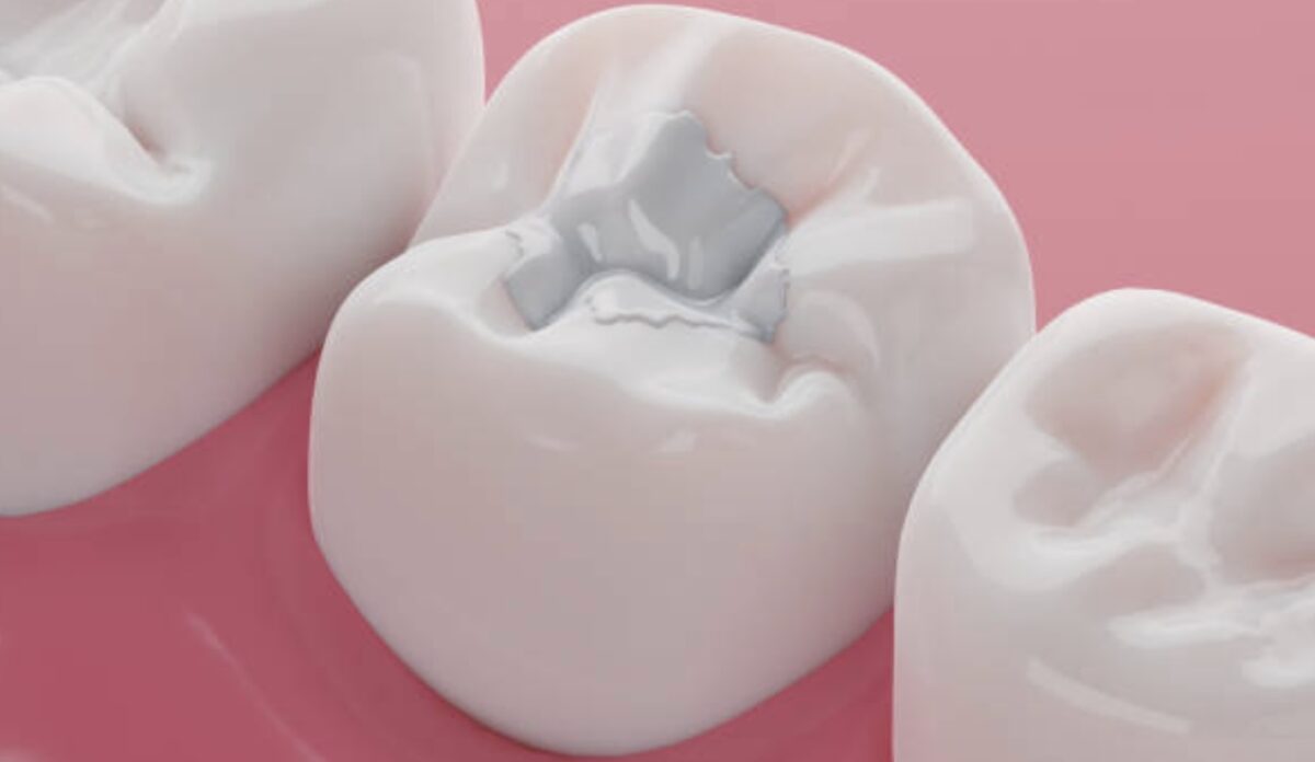 Berapa Biaya Menambal Gigi