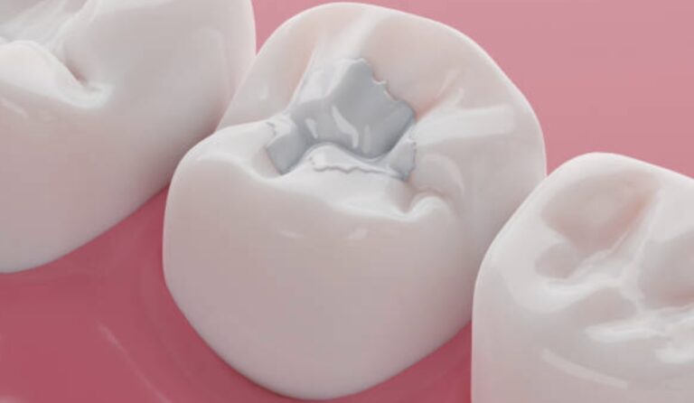 Berapa Biaya Menambal Gigi